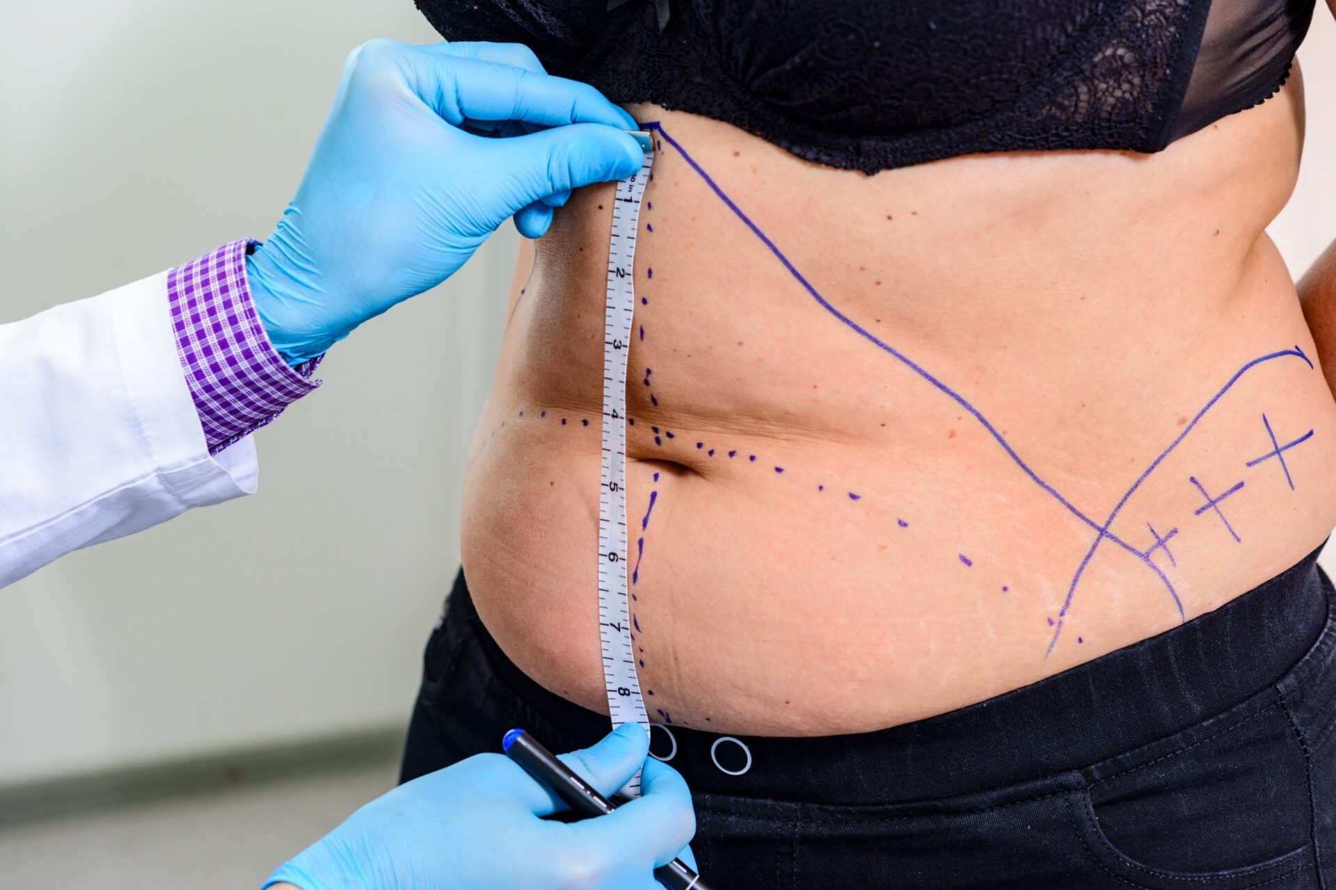 Doctor measures the size of the abdomen of a fat woman with a measuring tape