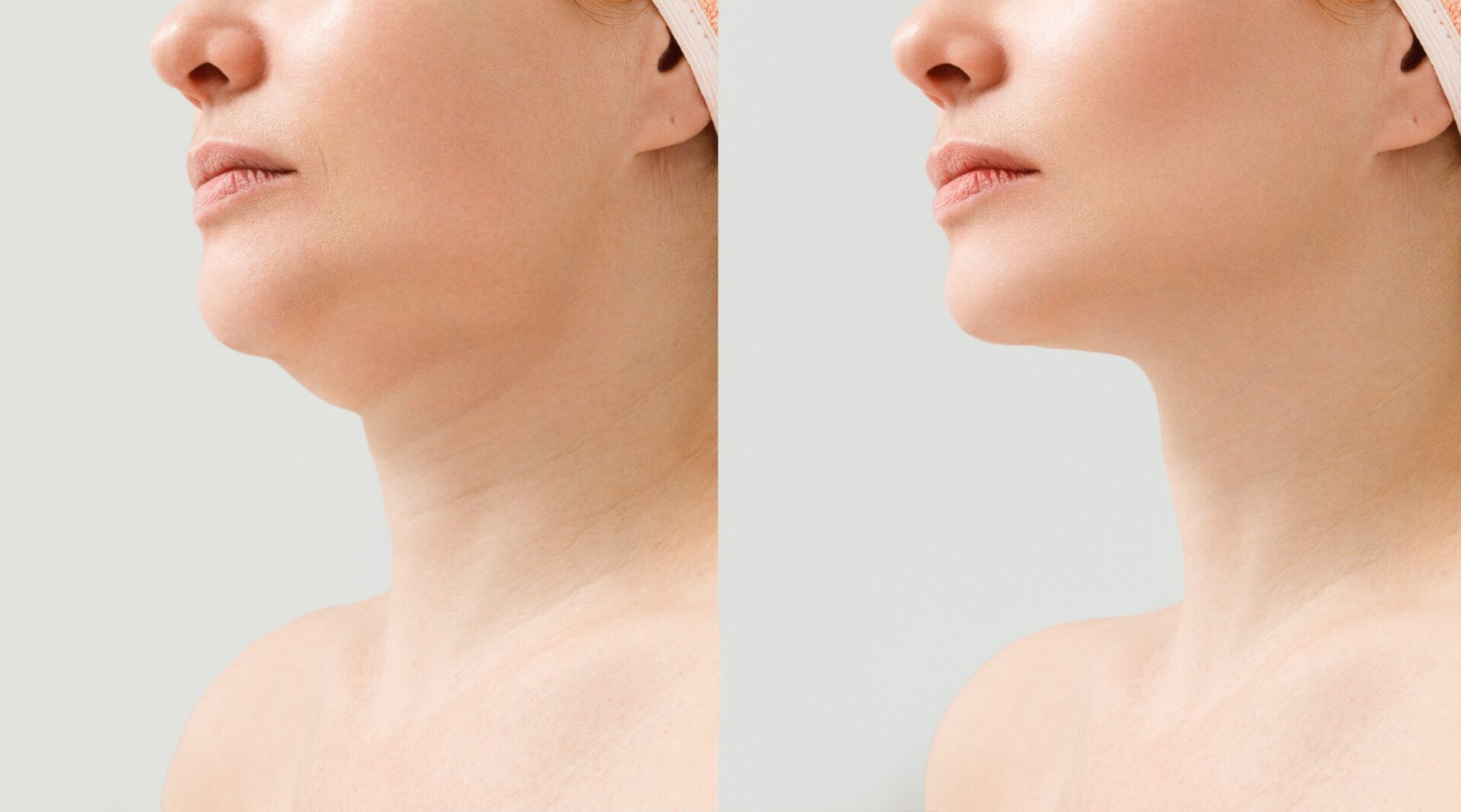 A woman's profile before and after a nose lift